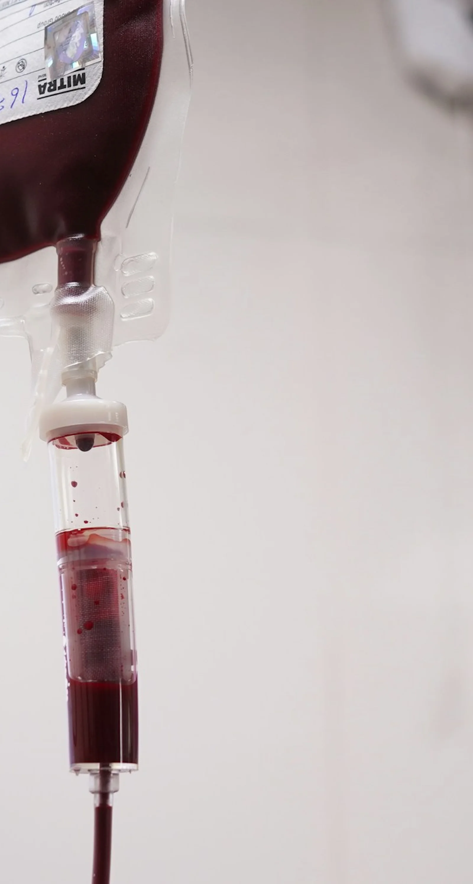 Bolsa de suero con cámara de goteo, preparada para la sesión